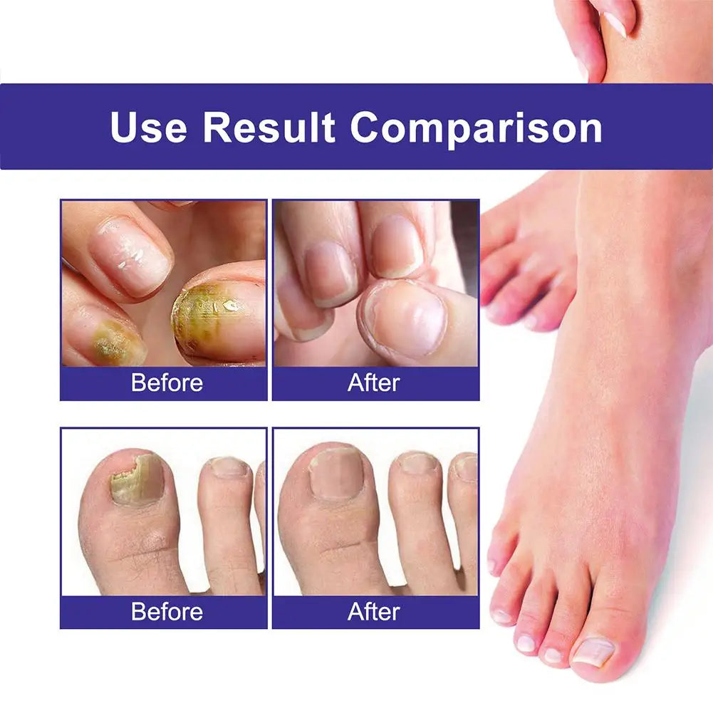 10PCS Nail Fungal Treatment Feet Care Essence Anti Infection Paronychia Toe Fungus Repair Nail Fungal Serum Removal Onychomy