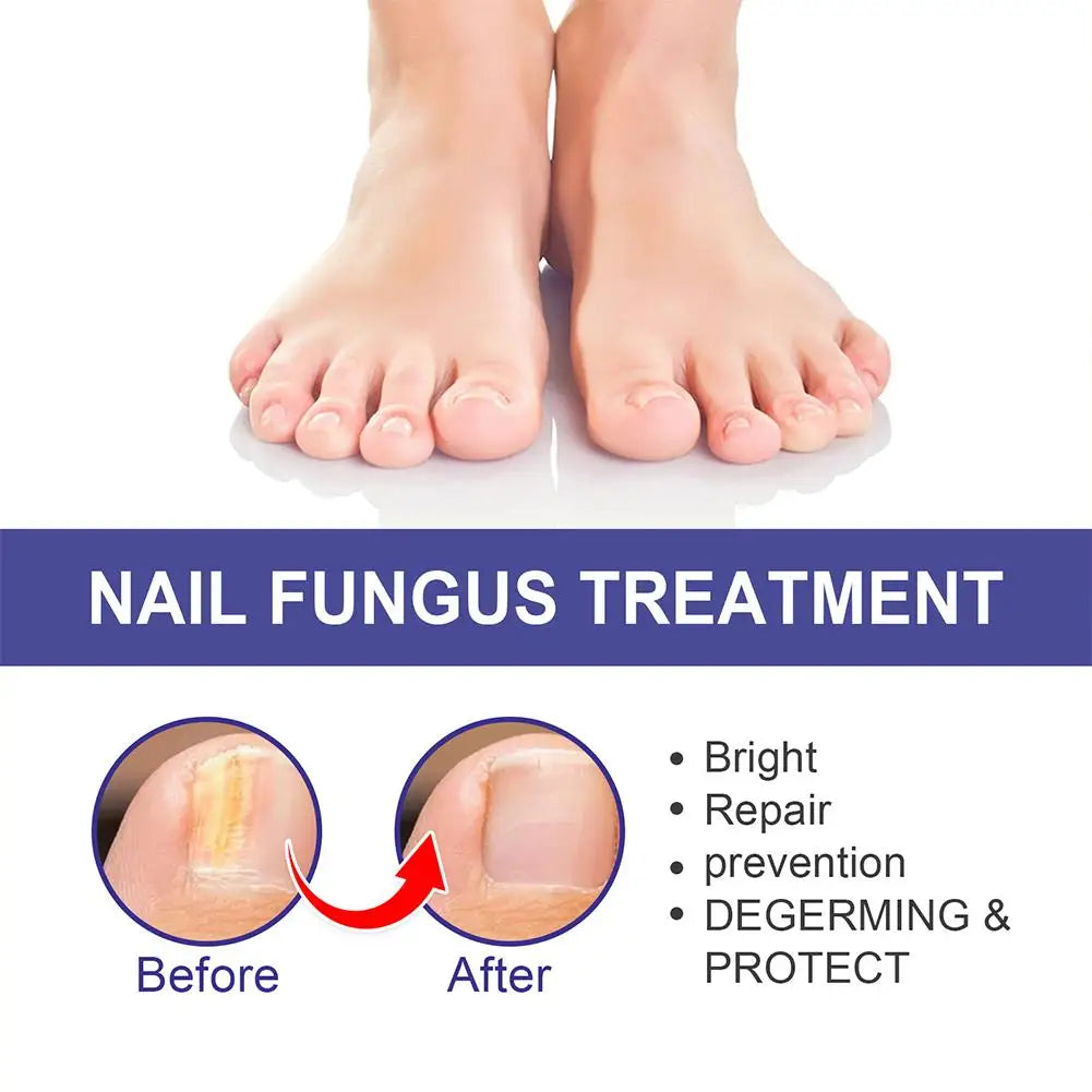10PCS Nail Fungal Treatment Feet Care Essence Anti Infection Paronychia Toe Fungus Repair Nail Fungal Serum Removal Onychomy