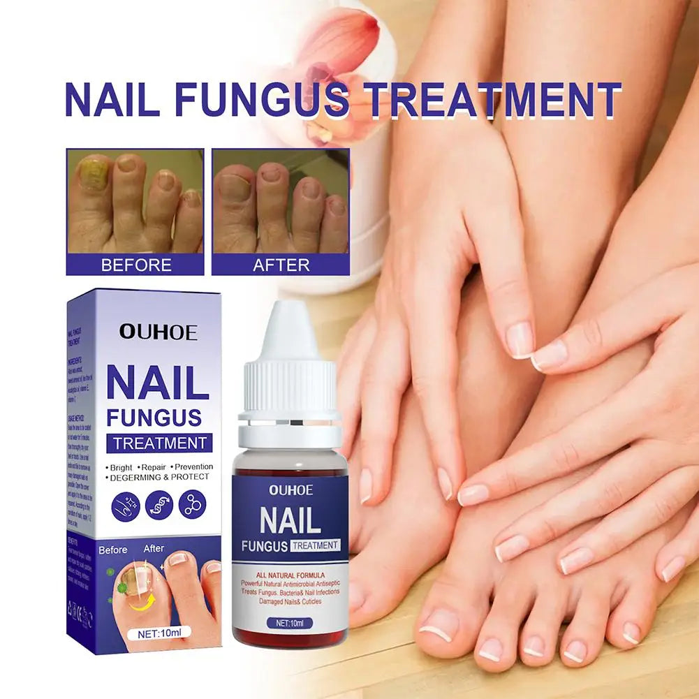 10PCS Nail Fungal Treatment Feet Care Essence Anti Infection Paronychia Toe Fungus Repair Nail Fungal Serum Removal Onychomy