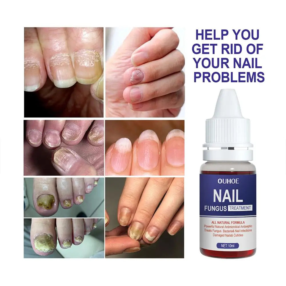 10PCS Nail Fungal Treatment Feet Care Essence Anti Infection Paronychia Toe Fungus Repair Nail Fungal Serum Removal Onychomy