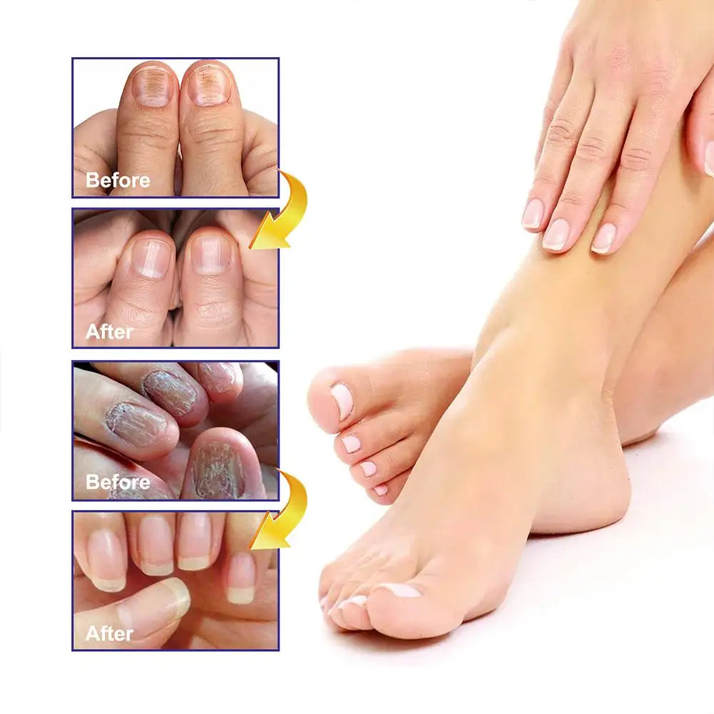 10PCS Nail Fungal Treatment Feet Care Essence Anti Infection Paronychia Toe Fungus Repair Nail Fungal Serum Removal Onychomy